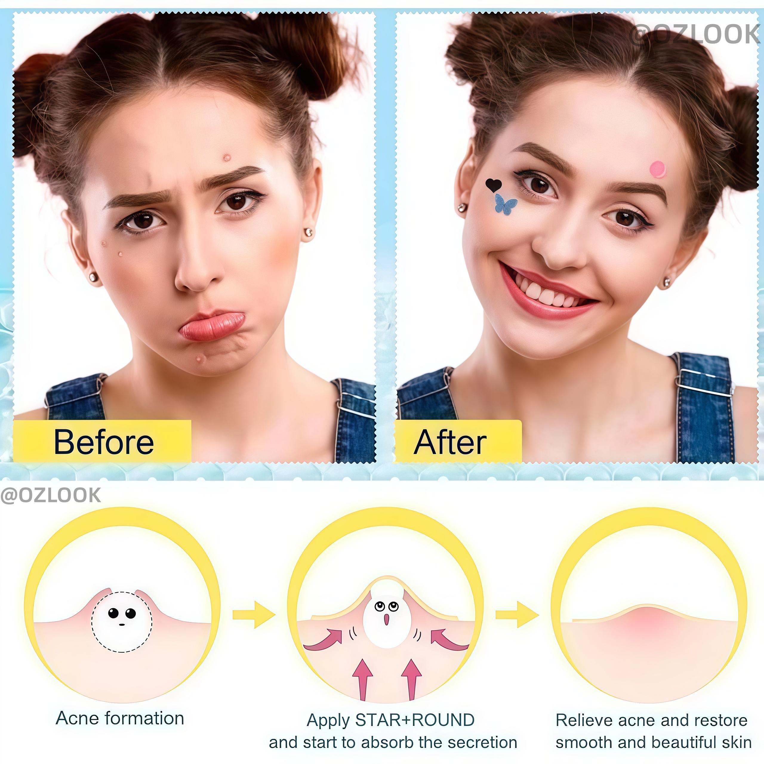 Jerawat Karakter Lucu Isi 160 Pcs Acne Pimple Patch Mengobati Mengangkat Isi Jerawat Dengan Desain Bintang Warna-warni
