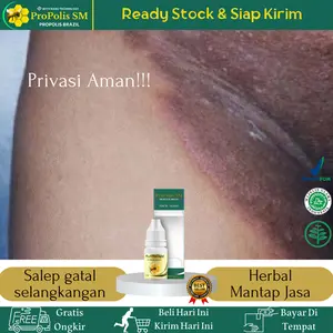 Propolis SM Salep gatal selangkangan, Mencerahkan Selangkangan hitam gelap, selangkangan berjamur, Tinea Cruris