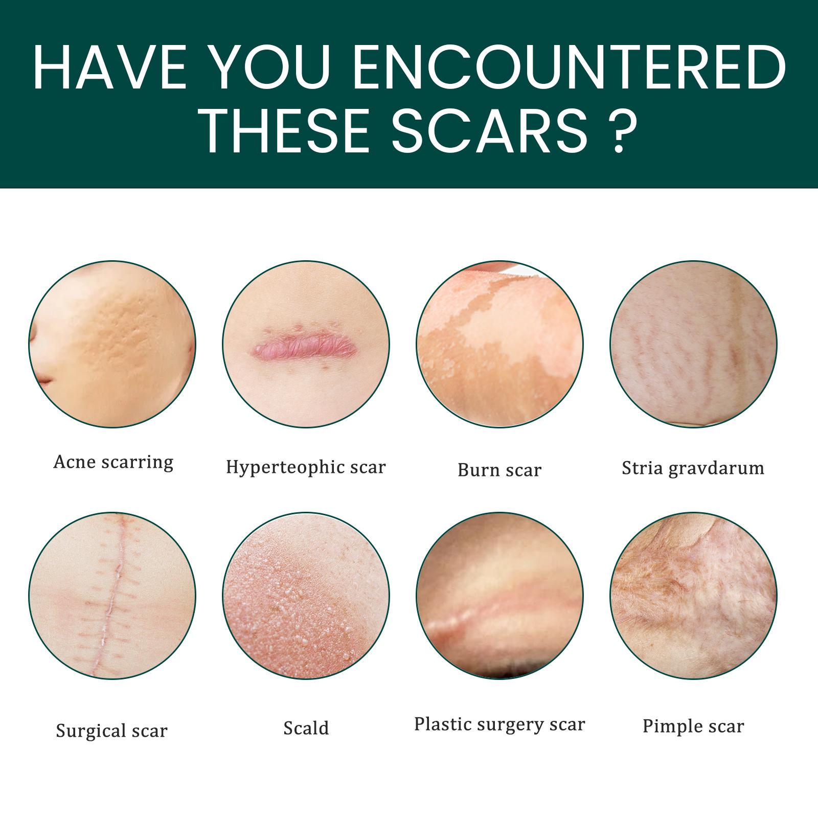 EELHOE Silicone Scar Sheets 1Roll Plester Silikon Penghilang Keloid Bekas Luka Silicon Keloid Plester Bekas Luka