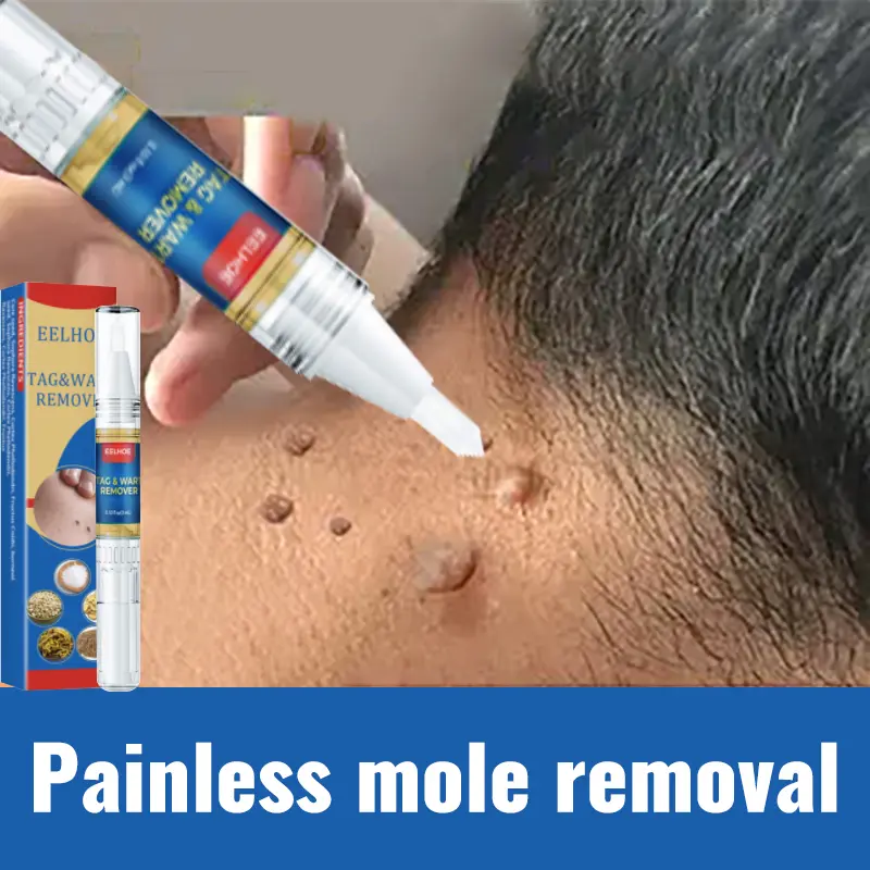 Wart Removal Pen Krim Penghilang Lalat, Krim Penghilang Kutil, Mudah Dibawa Untuk Semua Kulit, Krim Penghilang Kutil 0