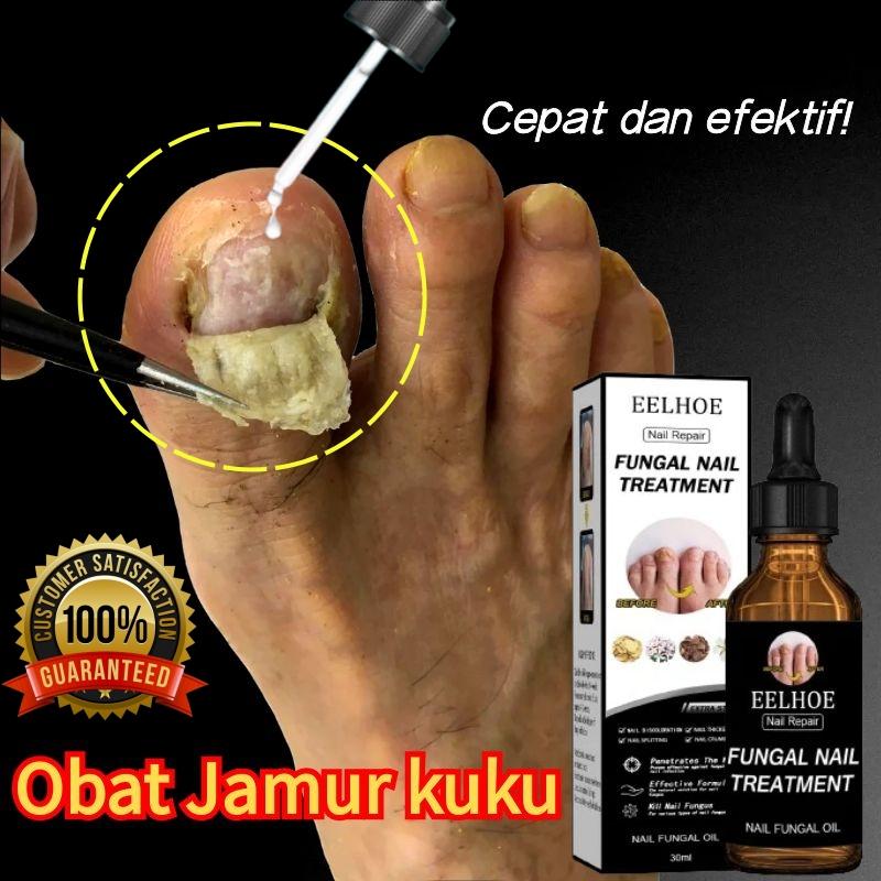 Obat Jamur Kuku Obat kuku jamur dan rusak Anti Jamur Nail Care Solusi perbaikan kuku kelabu Nail Repair Perawatan Kaki Pecah Nail Treatment - gel lidah buaya