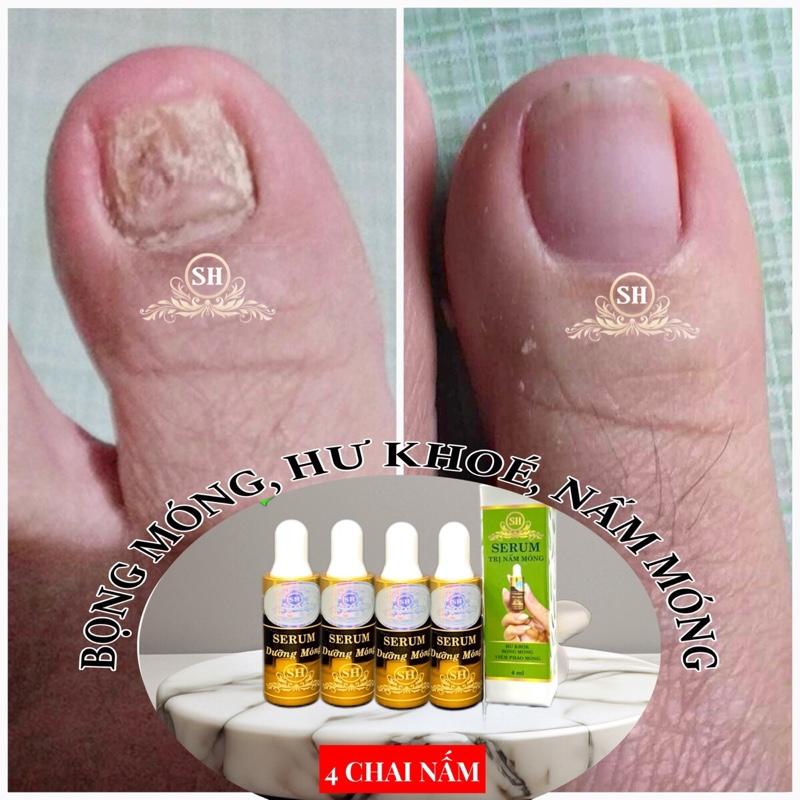 {CHÍNH HÃNG SH} 04 chai trị nấm móng bọng móng hư khoé phục hồi móng hư tổn Nữ dưỡng móng