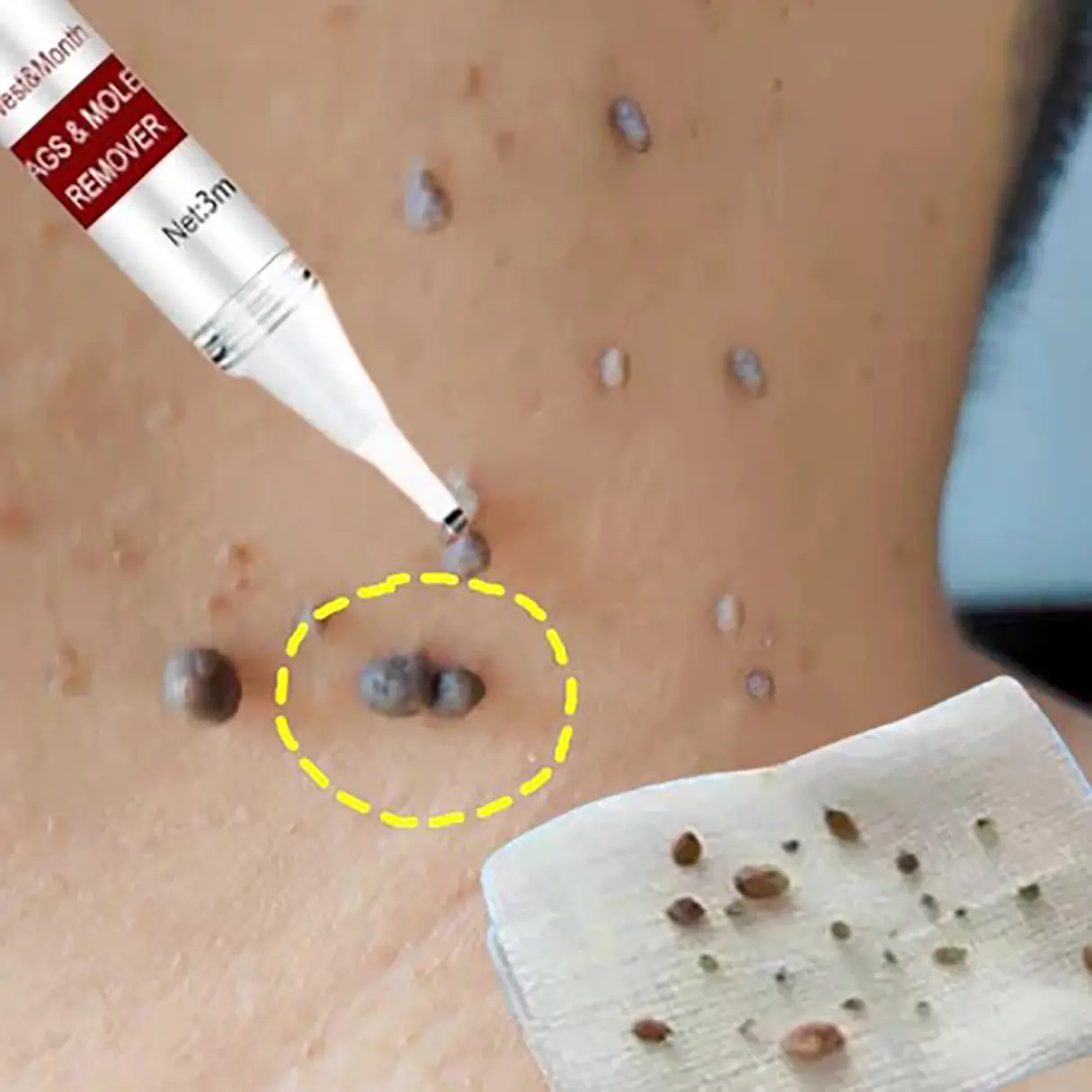 Penghilang Kutil Dan Tahi Lalat Penghilang tahi lalat di wajah Skin tag remover Penghilang kutil wajah Penghilang kutil di leher