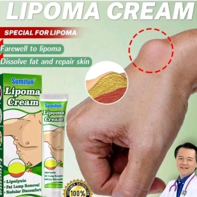 Krim lipoma ,krim untuk mengatasi bejolan lipoma ,uci uci Tubuh