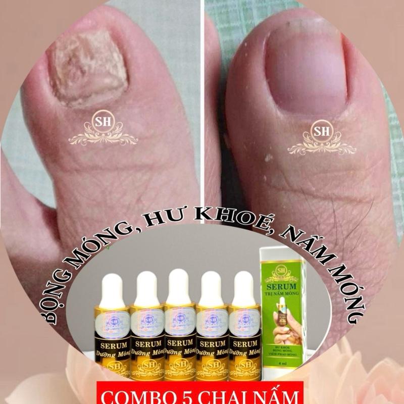  Serum Nấm Móng Dưỡng Móng Tay Chân Chính Hãng 05 lọ 4ml  