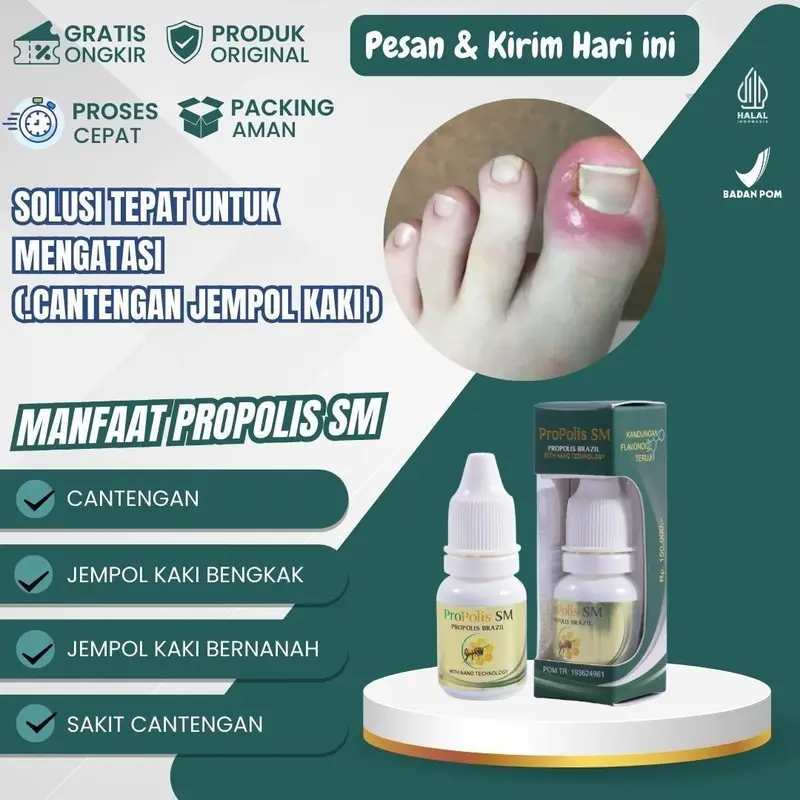 Propolis SM untuk Kuku Cantengan Jempol Kaki Bengkak Nyeri Bernanah Bau 0