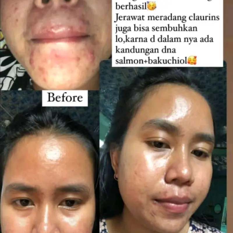 TERLARIS! ACNE TREATMENT SERIES Perawatan 2