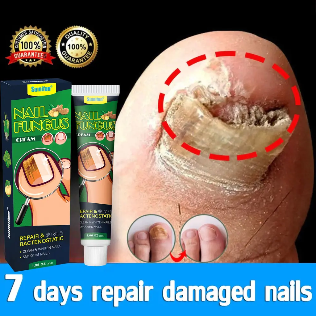 Nail Repair Perawatan Krim Jamur Kuku Nail Treatment Nail Fungus-20g