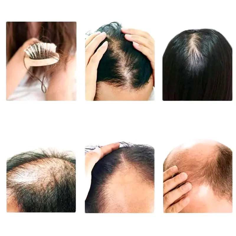 Minyak Rambut Menumbuhkan rambut botak, memperbaiki rambut rontok dan menebalkan jambang, jenggot dan kumis 1