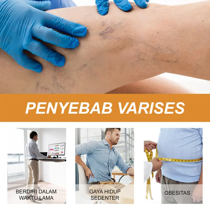 South Moon Krim Varises Vena Bulan Selatan mengurangi rasa sakit, bengkak, varises, vena kaki dan memperbaikinya, obat varises merah 2