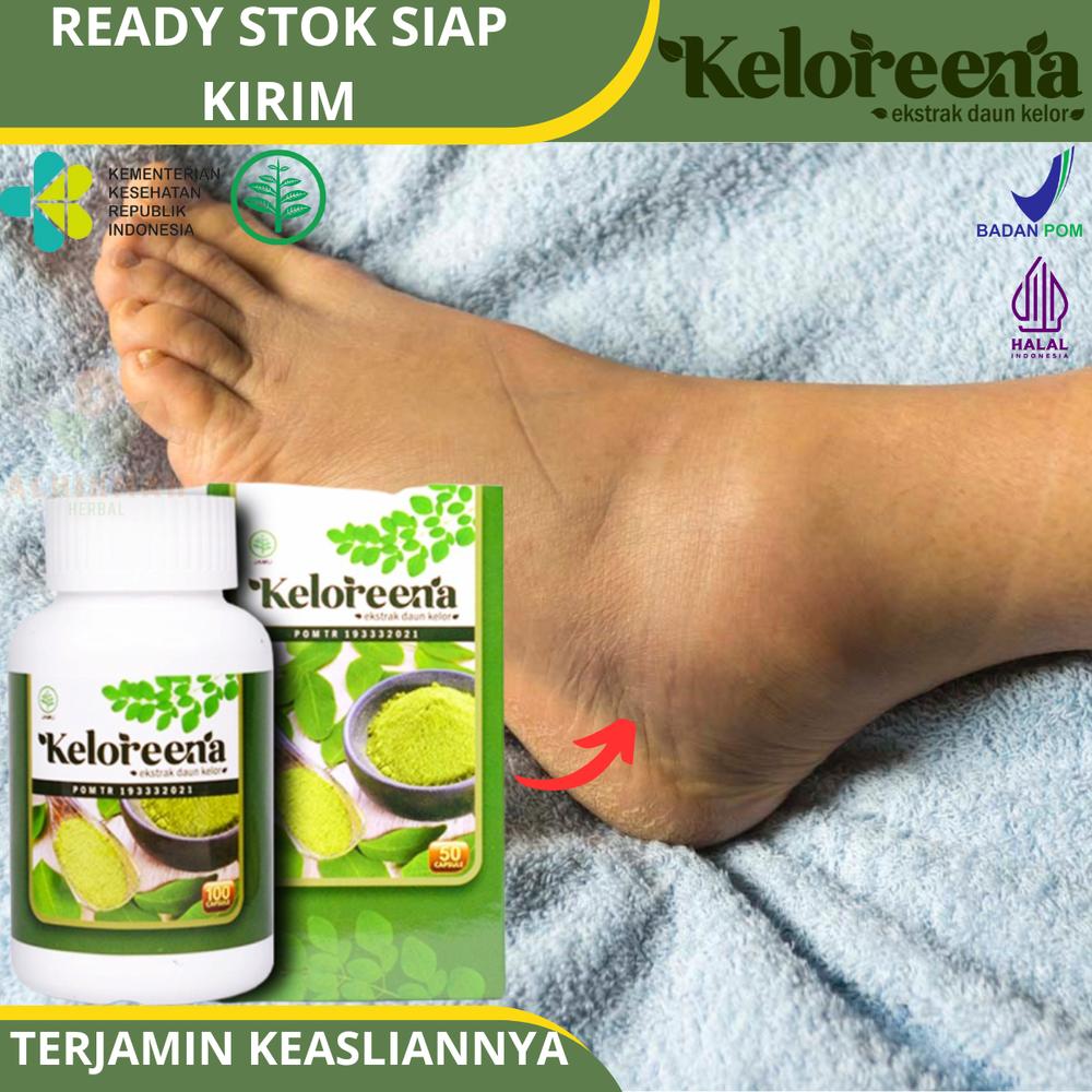 KELOREENA - Untuk Mata Kaki Bengkak Karena Asam Urat / Keseleo, Sakit Di Pergelangan Kaki, Radang Sendi Pada Tumit Dan Mata Kaki - 50 Kapsul