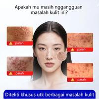 Gambar Krim Penghilang Bekas Luka & Jerawat-30g Penghilang bekas jerawat Krim wajah-Obat jerawat pemulihan bekas-Mencegah Luka Jadi Keloid & Menyamarkan Bekas Hitam - 30ML dari Sumifun Beauty Indonesia Kab. Bekasi 3 Tokopedia
