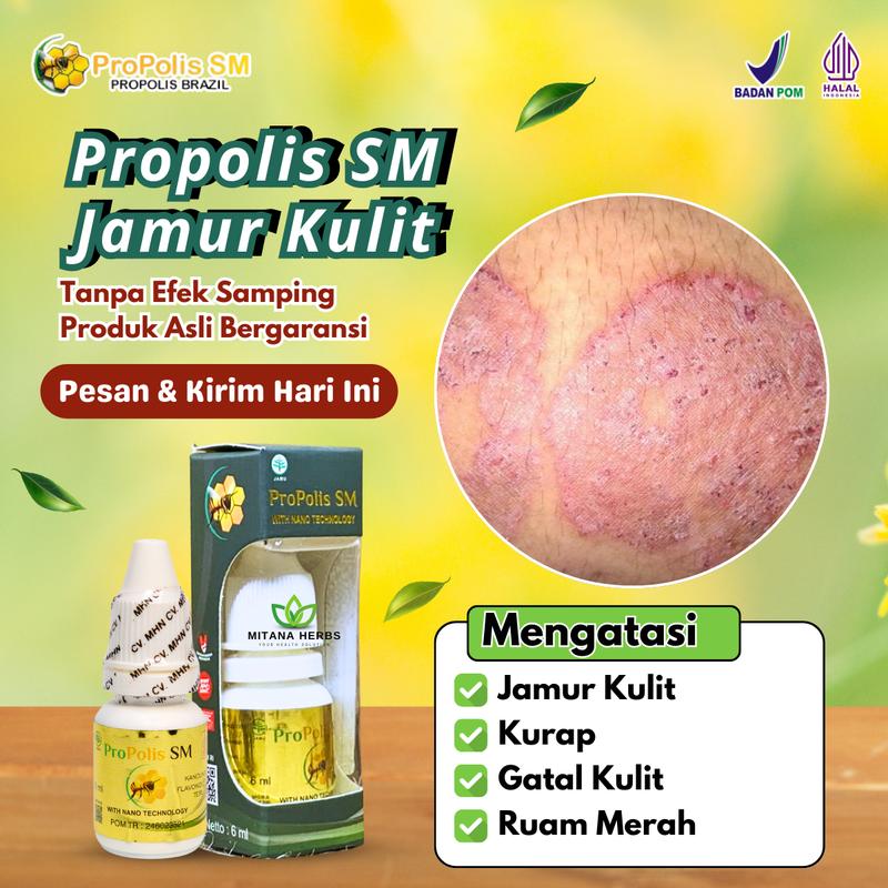 Propolis SM Salep Jamur Kulit Kurap Gatal Kulit Ruam Merah Kering ...