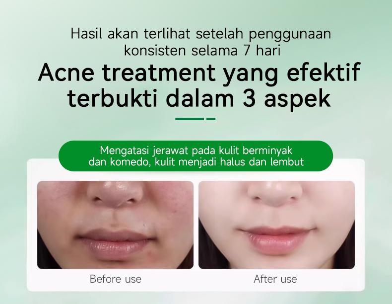 Product Introduction of （T1）BPOM.Beli 2 Gratis 1.Challenge 7 Hari Jerawat Hilang,CINSULIN Obat Jerawat Herbal Ekstrak Alami Cepat Hilangkan Komedo & Jerawat Meradang  BPOM Certified  Aman untuk Remaja & Kulit Sensitif Berjerawat Wajah Gatal Beruntusan 11