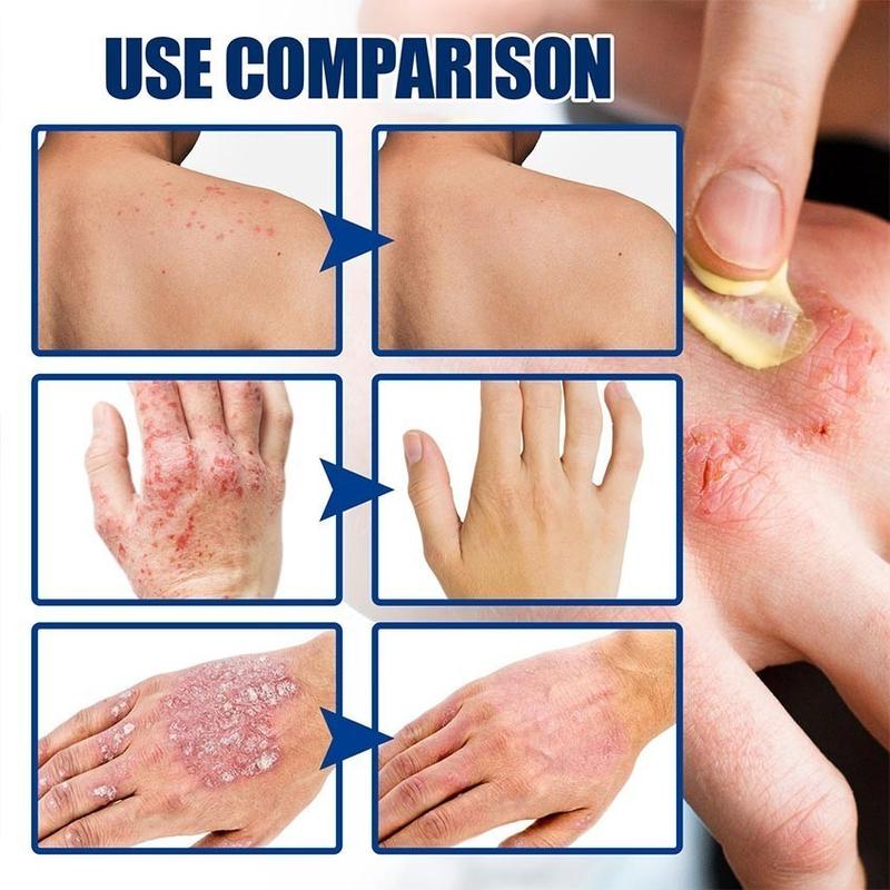 Product Introduction of South Moon Salep Khusus Psoriasis - psoriasis ointment - Kurap Pada Kulit Kepala - Kutu Air - Kurap Pada Badan - Eksim - Infeksi Kulit - Obat Luar Mengatasi Gatal 20g Perawatan Tubuh Kering Pembersihan 1
