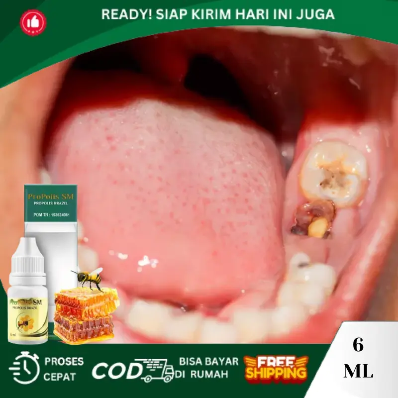 Sakit Gigi Berlubang, Penghancur Gigi Berlubang, Tetes Sakit Gigi, Gusi Bengkak, Radang Gusi, Gigi Ngilu, Pereda Nyeri Sakit Gigi, Gigi Bolong 0