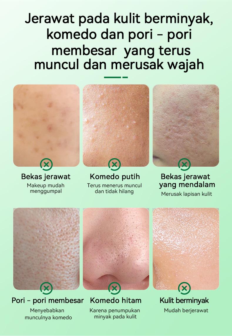 Product Introduction of （T1）BPOM.Beli 2 Gratis 1.Challenge 7 Hari Jerawat Hilang,CINSULIN Obat Jerawat Herbal Ekstrak Alami Cepat Hilangkan Komedo & Jerawat Meradang  BPOM Certified  Aman untuk Remaja & Kulit Sensitif Berjerawat Wajah Gatal Beruntusan 1