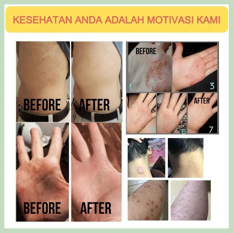 Salep gatal Salep Eksim Salep kulit Krim psoriasis paling ampuh Kulit Kepala Psoriasis Tangan Tinea Kaki Bau Versicolor Menghambat Dermatitis Jamur Anti Gatal Cream 20G
