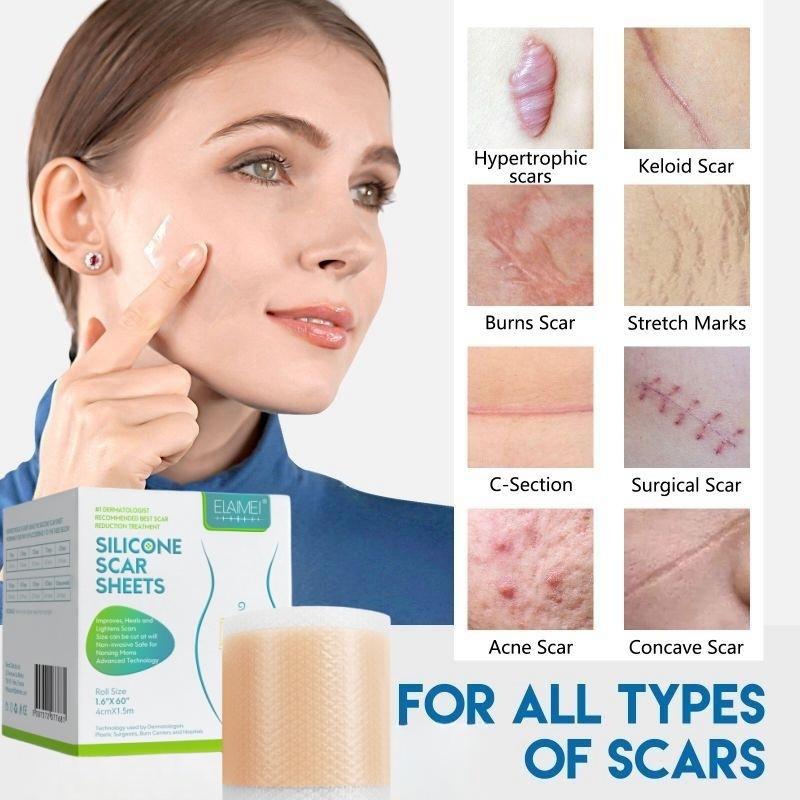 ⭐️ORI⭐️ELAIMEI Silicone Scar Sheets Patch Penghilang Keloid Tambalan Stretch Mark Surgery Scar Removal Silicone Repair Tape 4cm x 1.5m - Ready 0