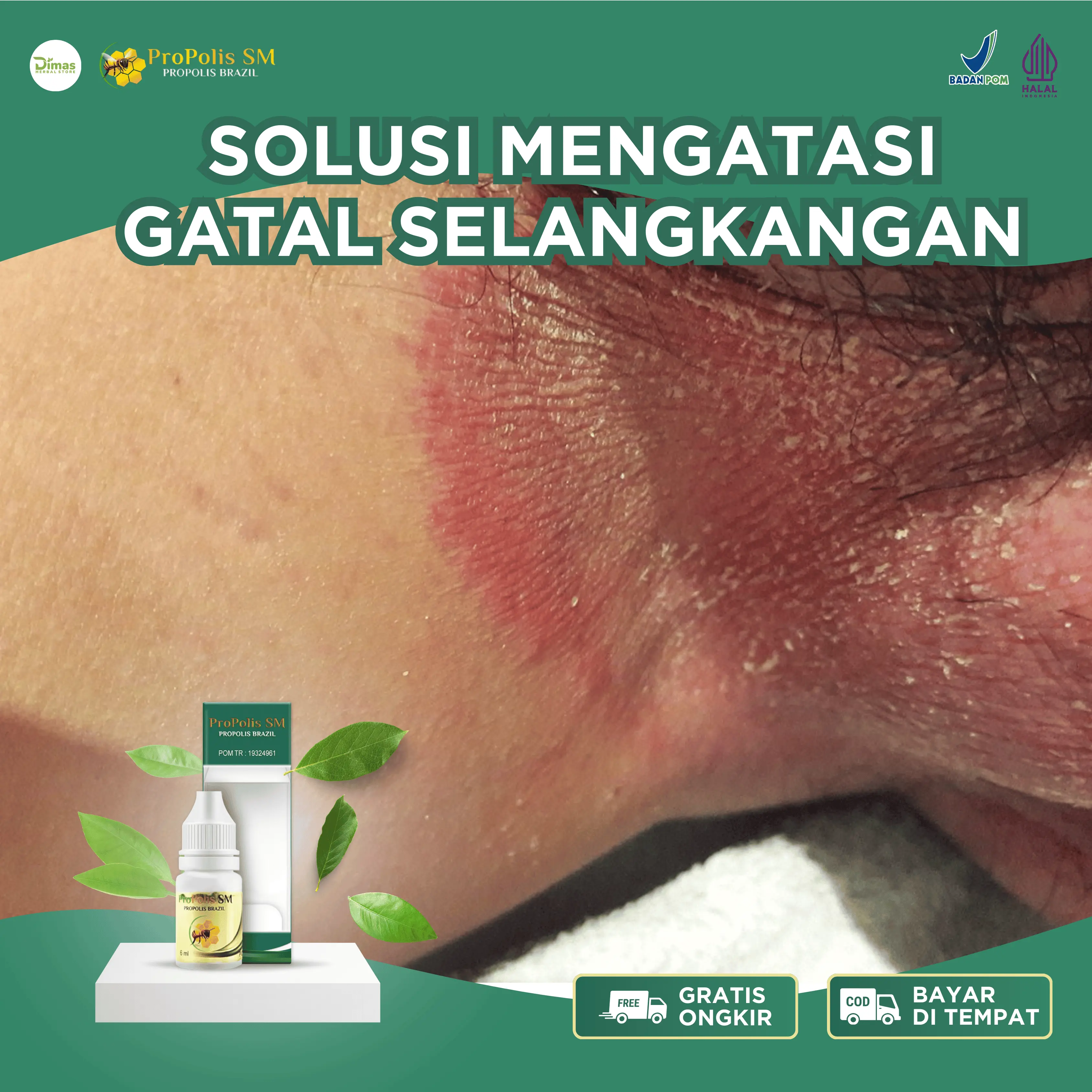 Propolis SM Gatal Selangkangan, Selangkangan Berjamur, Selangkangan Paha Gatal, Selangkangan Hitam Dan Lecet, Menghilangkan Rasa Gatal Selangkangan Dengan Propolis SM