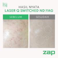 Gambar Facial Express + Laser Q-Switch Nd:Yag Double (2000 Shots) + IPL Rejuvenation Double (250 Shots) + Oxy Infusion Brightening +  Juva Vitaglow Peeloff Mask dari ZAP Clinic Kota Administrasi Jakarta Selatan 2 Tokopedia