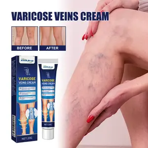 South Moon Varicose Veins Cream Obat Varises Salep Penghilang Varises Vaskulitis 20g
