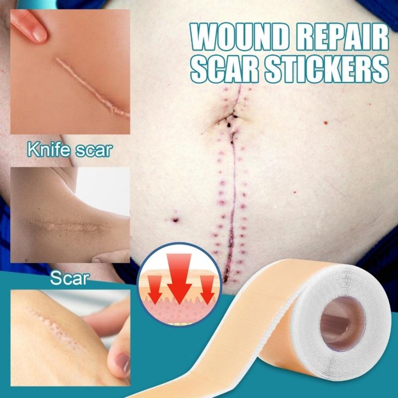 ⭐️ORI⭐️ELAIMEI Silicone Scar Sheets Patch Penghilang Keloid Tambalan Stretch Mark Surgery Scar Removal Silicone Repair Tape 4cm x 1.5m - Ready 6