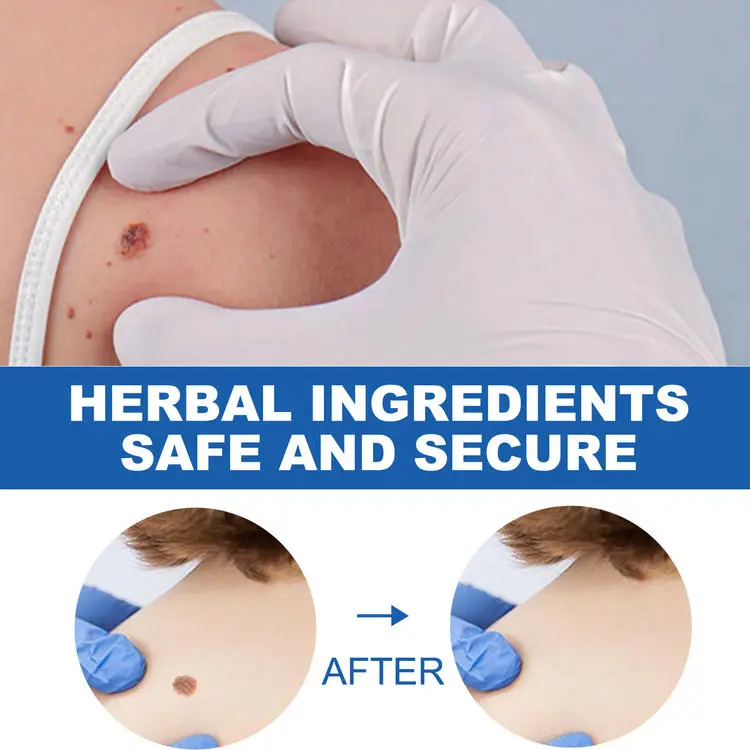 Wart Removal Pen Krim Penghilang Lalat, Krim Penghilang Kutil, Mudah Dibawa Untuk Semua Kulit, Krim Penghilang Kutil 4
