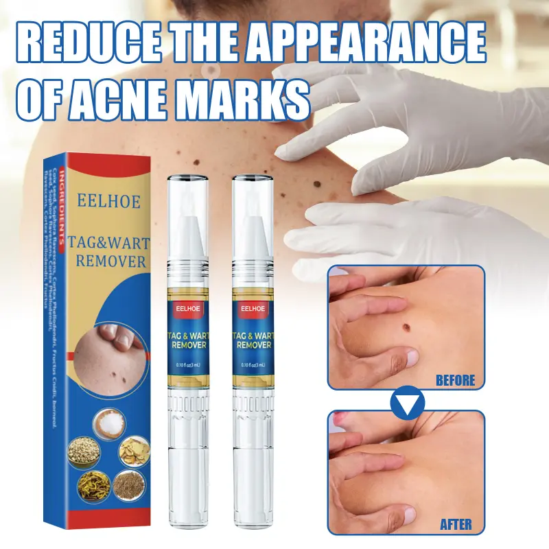Wart Removal Pen Krim Penghilang Lalat, Krim Penghilang Kutil, Mudah Dibawa Untuk Semua Kulit, Krim Penghilang Kutil 2