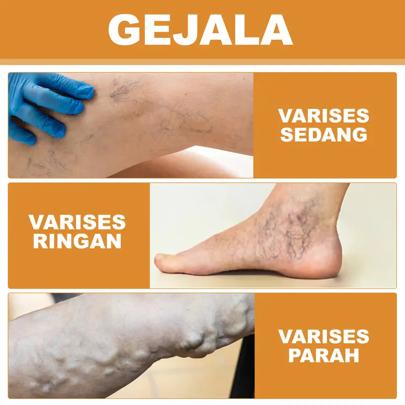 South Moon Krim Varises Vena Bulan Selatan mengurangi rasa sakit, bengkak, varises, vena kaki dan memperbaikinya, obat varises merah 5