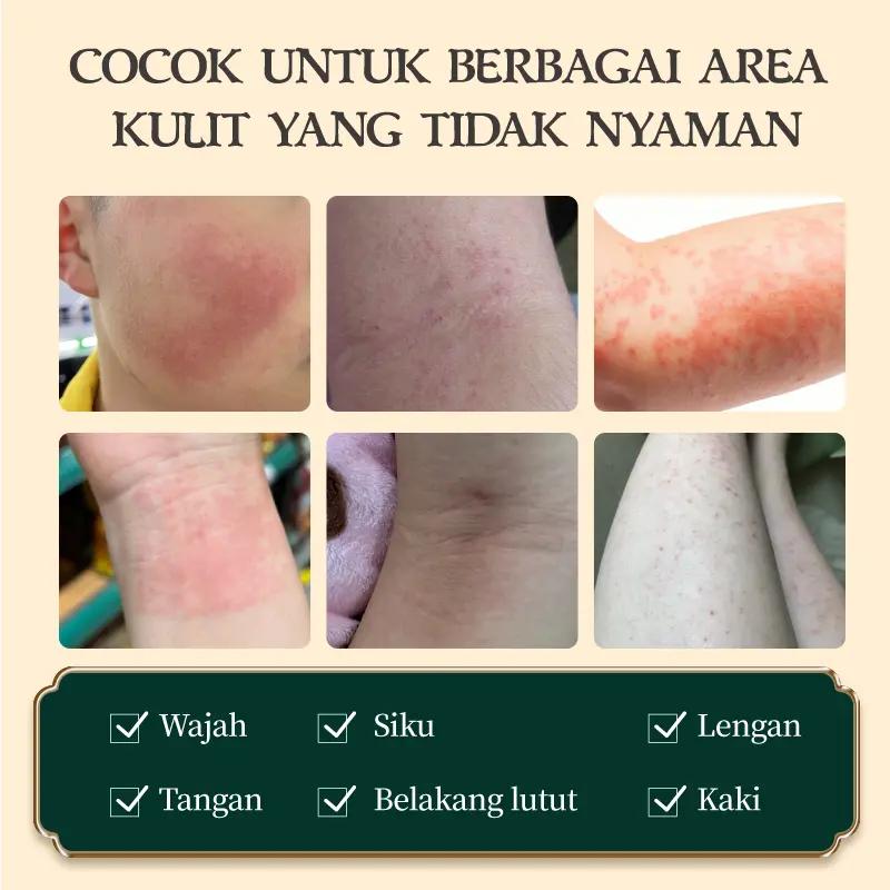 Dr.YuTitan Krim Gatal Kulit – Skin Soothing Cream untuk Area Sensitif & Nyaman