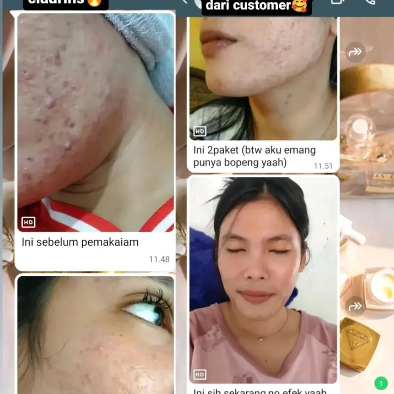 TERLARIS! ACNE TREATMENT SERIES Perawatan 3