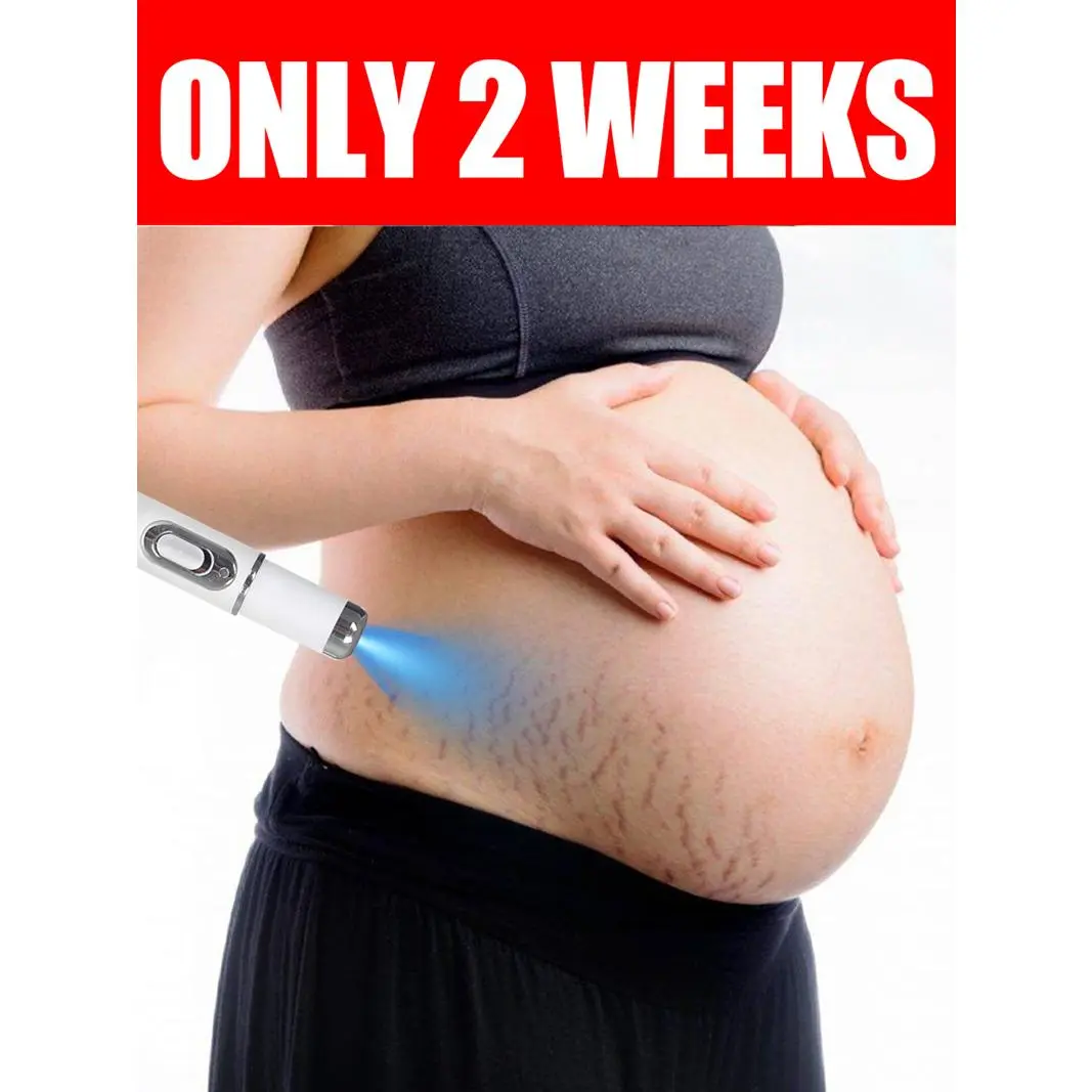 stretch marks permanent removal laser products