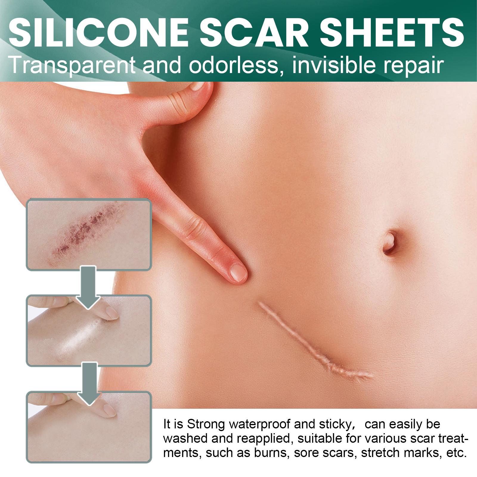EELHOE Silicone Scar Sheets 1Roll Plester Silikon Penghilang Keloid Bekas Luka Silicon Keloid Plester Bekas Luka