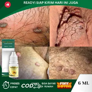 Penghancur Kutil Kelamin, Kutil Kelamin HPV, Papiloma Jengger Ayam, Perontok Skin Tag, Perontok Kutil Kelamin Pria, Kutil Kemaluan