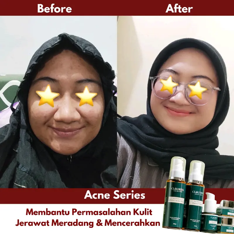 TERLARIS! ACNE TREATMENT SERIES Perawatan 4