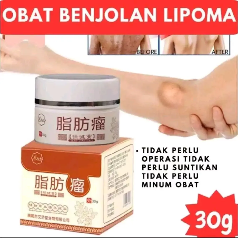 ZHI FANG LIU – Lipoma Cream Herbal Pengurang Benjolan Lemak 30g