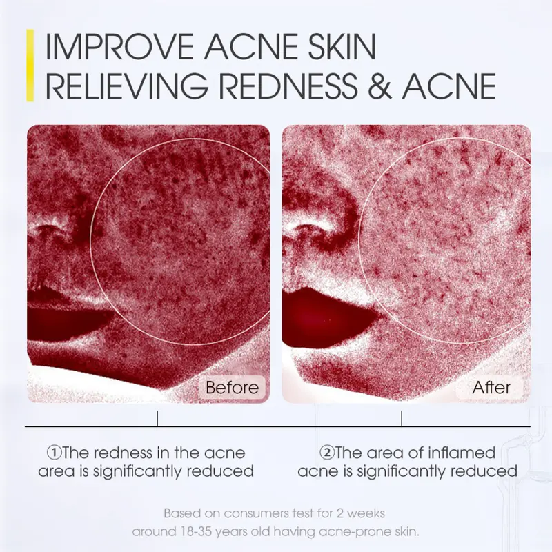 SKINEVER Salicylic Acid Acne Treatment Sleep Mask Centella Soothing Mask Brightening Sunscreen 3ml pembersih wajah berjerawat 5