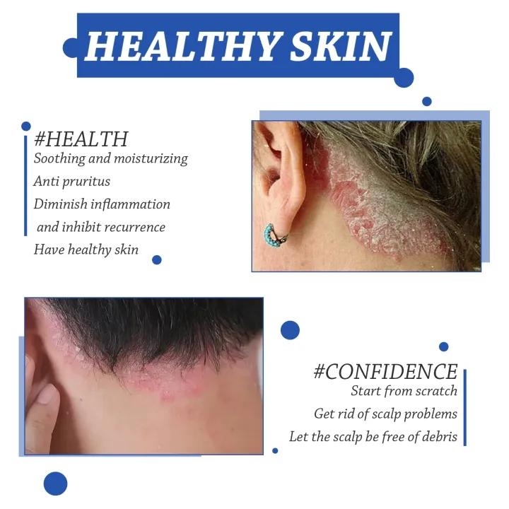 Shampo anti ketombe Penghilang ketombe berkerak dan gatal psoriasis kulit kepala Oil control Kulit kepala gatal Shampoo rambut 5