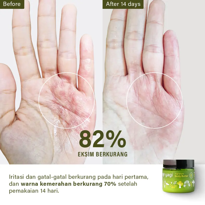 Yagi Forest Signature Body Butter 50gr Psoriasis Stretchmark Memudarkan Mengelupas Lavender Kering 1