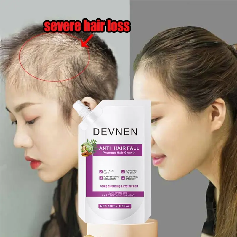 DEVNEN sampo anti rambut rontok 300ML Hair Growth Shampoo shampo penumbuh rambut cepat Anti rambut rontok Botak ginger shampoo kontrol minyak menyegarkan pelembab nutrisi Conditioner Haircare Ketombe Lebat 0