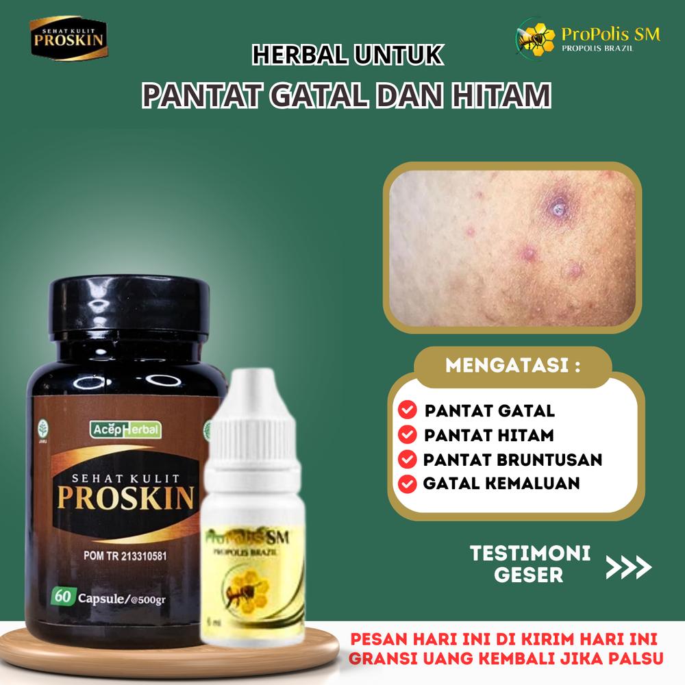 ProPolis SM untuk Gatal Pantat Dan Selangkangan atasi Gatal Pada Kemaluan, Pantat Burik dan Bruntusan Hitam - TETES PROPOLIS SM