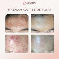 Gambar ASLEY Paket Acne 1 Serum Acne Care dan Dermasley Night Cream Acne Glow skincare untuk jerawat dari Klinik Spesialis Jerawat Kab. Karawang 5 Tokopedia