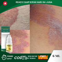 Gambar Gatal Selangkangan, Selangkangan Hitam Dan Gatal, Pemutih Selangkangan Hitam, Herbal Tetes Selangkangan, Kurap Di Selangkangan, Penghilang Hitam Diselangkangan, Selangakangan Lecet Berjamur - Propolis SM dari Dyna Herbs Kota Administrasi Jakarta Barat 1 Tokopedia
