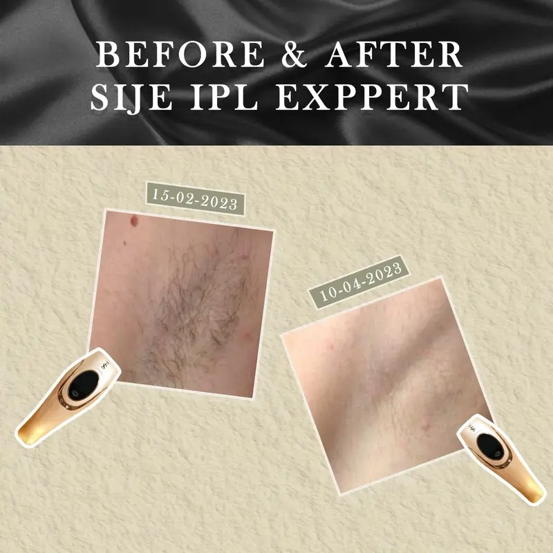 Sije Expert IPL Home Device Hair Removal Ketiak  Perawatan 3