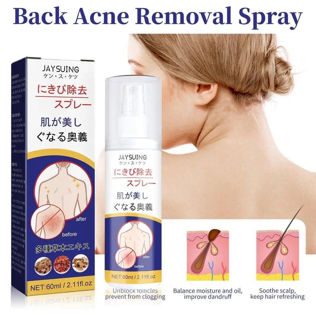 Xịt Loại Bỏ Mụn Trứng Cá Toàn Thân, 60ml, Làm Dịu Và Dưỡng Ẩm, Thu Nhỏ Lỗ Chân Lông