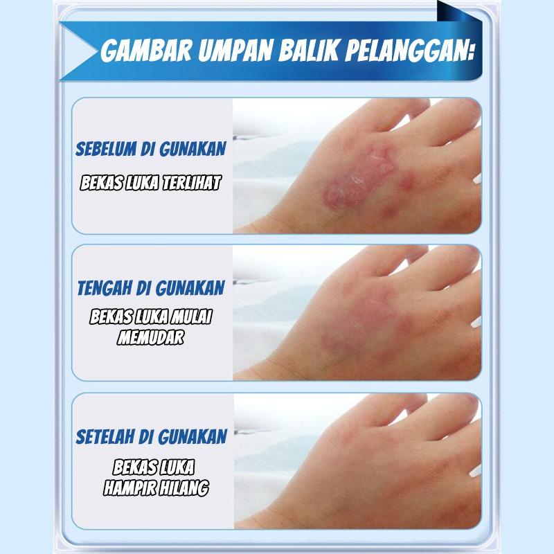 Original Import Cream Penghilang Bekas Luka Krim Ampuh PenghilangJerawat Bekas Cacar Gatal Koreng Gigitan Nyamuk Serangga Luka Air Panas Knalpot Perawatan Penghilang Bekas Luka Stretch Mark Keloid Cream Salep Luka Bakar Lama Jerawat Koreng