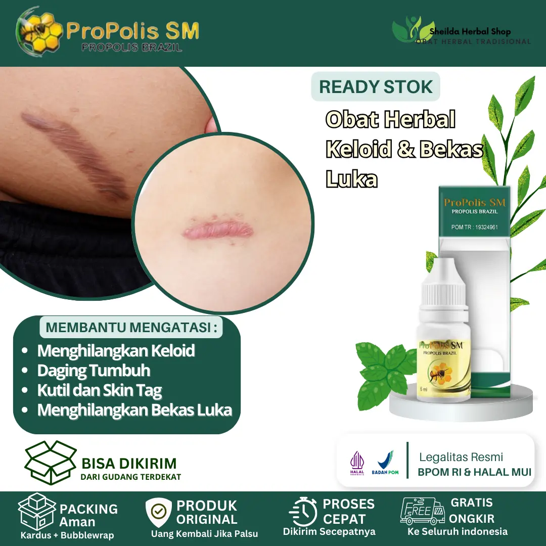 Propolis SM Keloid, Daging Tumbuh, Daging Jadi, Penghilang Keloid Bekas Operasi, Penumpas Daging Tumbuh, Penghilang Bekas Luka