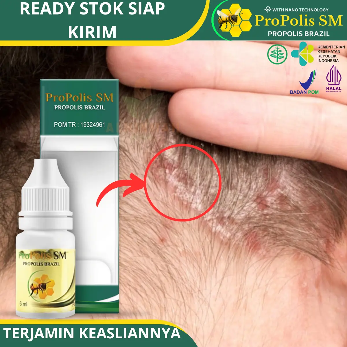Propolis SM - Salep Cair Untuk Koreng Gatal Di Kulit Kepala karena Ketombe Berkerak dan Bersisik Ketombe Parah Psoriasis kulit kepala