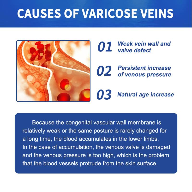 Product Introduction of South Moon Pijat Vena Varises Krim Perbaikan Kaki Cacing Tanah Meringankan Vena Varises yang Menonjol di Kaki Extract Ceramide 6